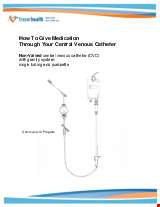 PDF Thumbnail for How to Give Medication Through Your Central Venous Catheter (NON-Valved) with Gravity System, Single Tubing, and PUMPETTE
